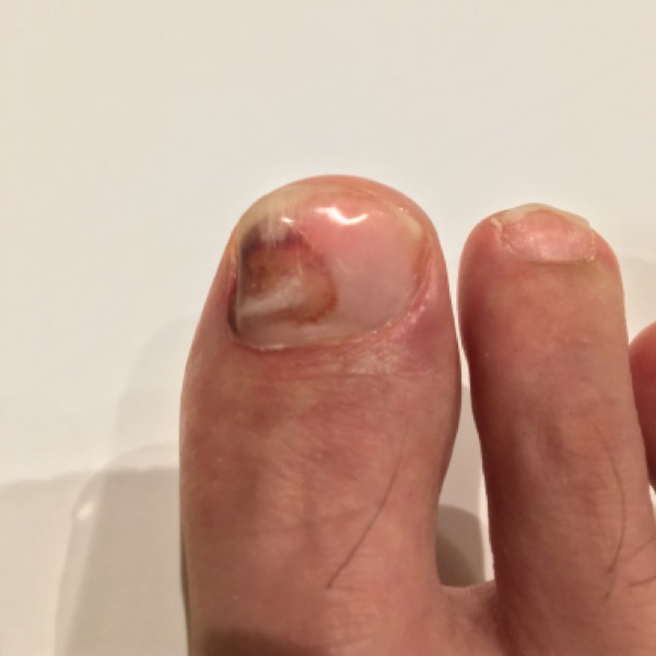 爪の症例 登山 下山 で爪が痛い爪下血腫 放置は絶対ng 予防策は爪切り アスリートサロン アスリートネイル ケアで爪を強く美しく爪 のコンディショニング専門メディア