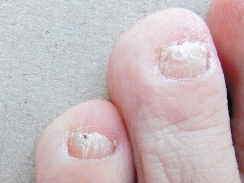 解説まとめ 爪白癬 爪水虫 の症状と原因 予防方法 アスリートは白癬菌の早期治療が必須 アスリートサロン アスリートネイル ケアで爪を強く美しく爪 のコンディショニング専門メディア