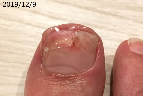 続報 登山 下山 で負った爪下血腫 回復までの10ヶ月を爪の専門家が解説 アスリートサロン アスリートネイル ケアで爪を強く美しく爪 のコンディショニング専門メディア