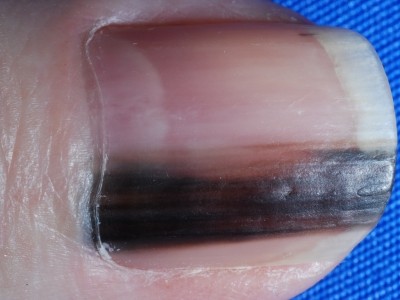 爪が真っ黒に 3つの病状の見分けと原因を徹底解説 爪下血腫と黒色線条とメラノーマ
