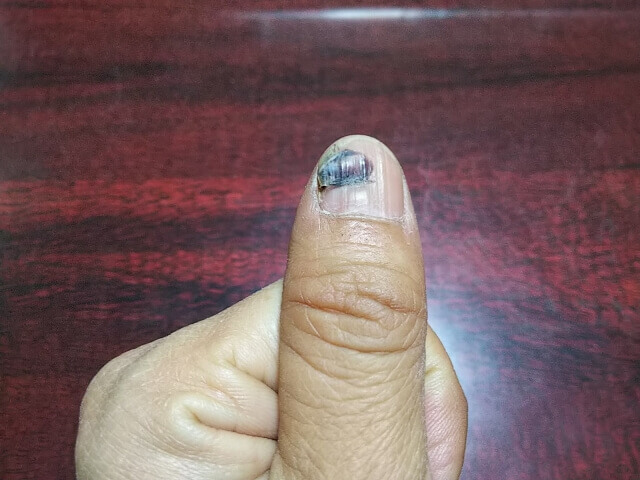 プルニーフィンガーの治療方法