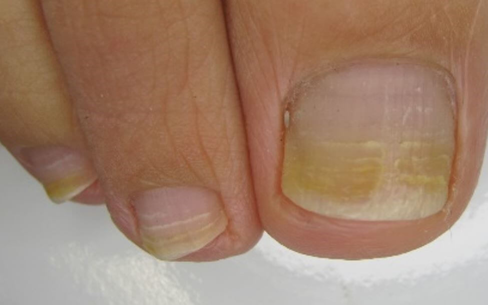 なぜ爪がでこぼこに 爪甲横溝の原因と予防方法を解説 爪の横筋や凸凹を改善するコツ